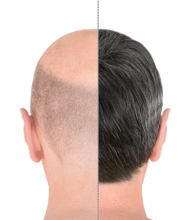 Scalp Micropigmentation (SMP)