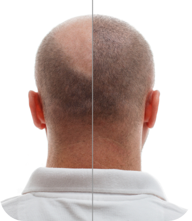 Finasteride (Propecia) for Hair Loss