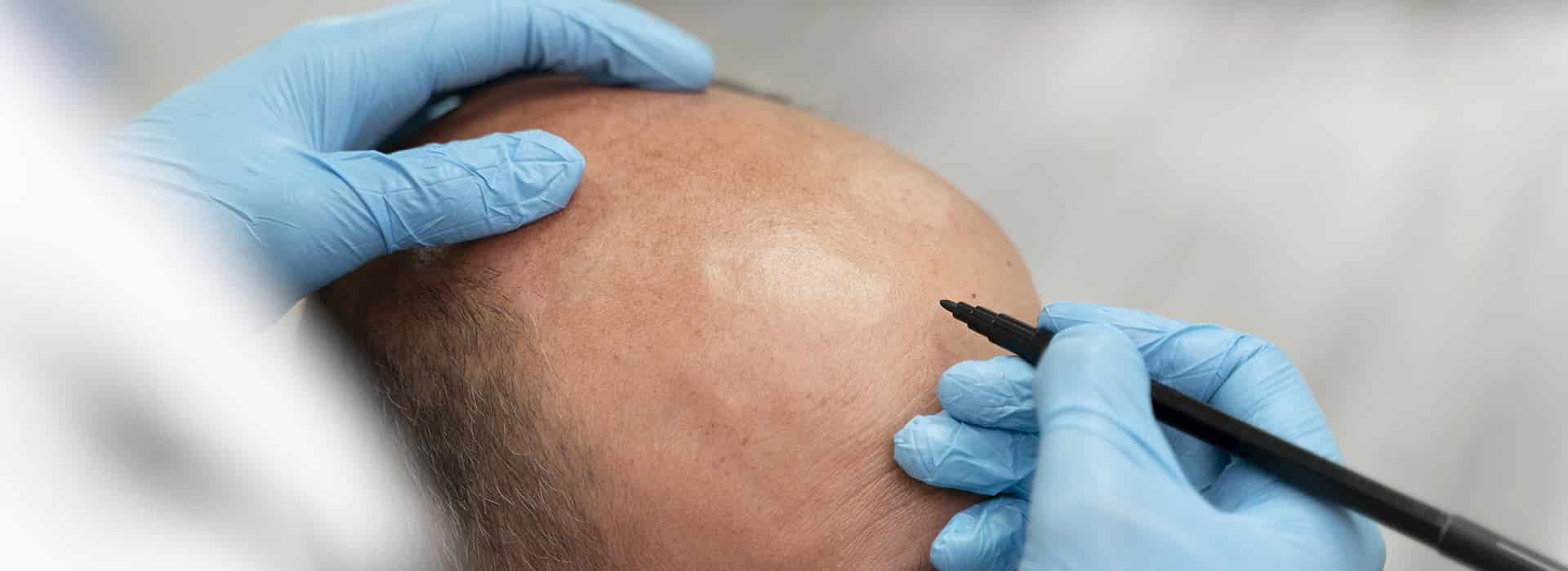 long island hair transplant specialize fue