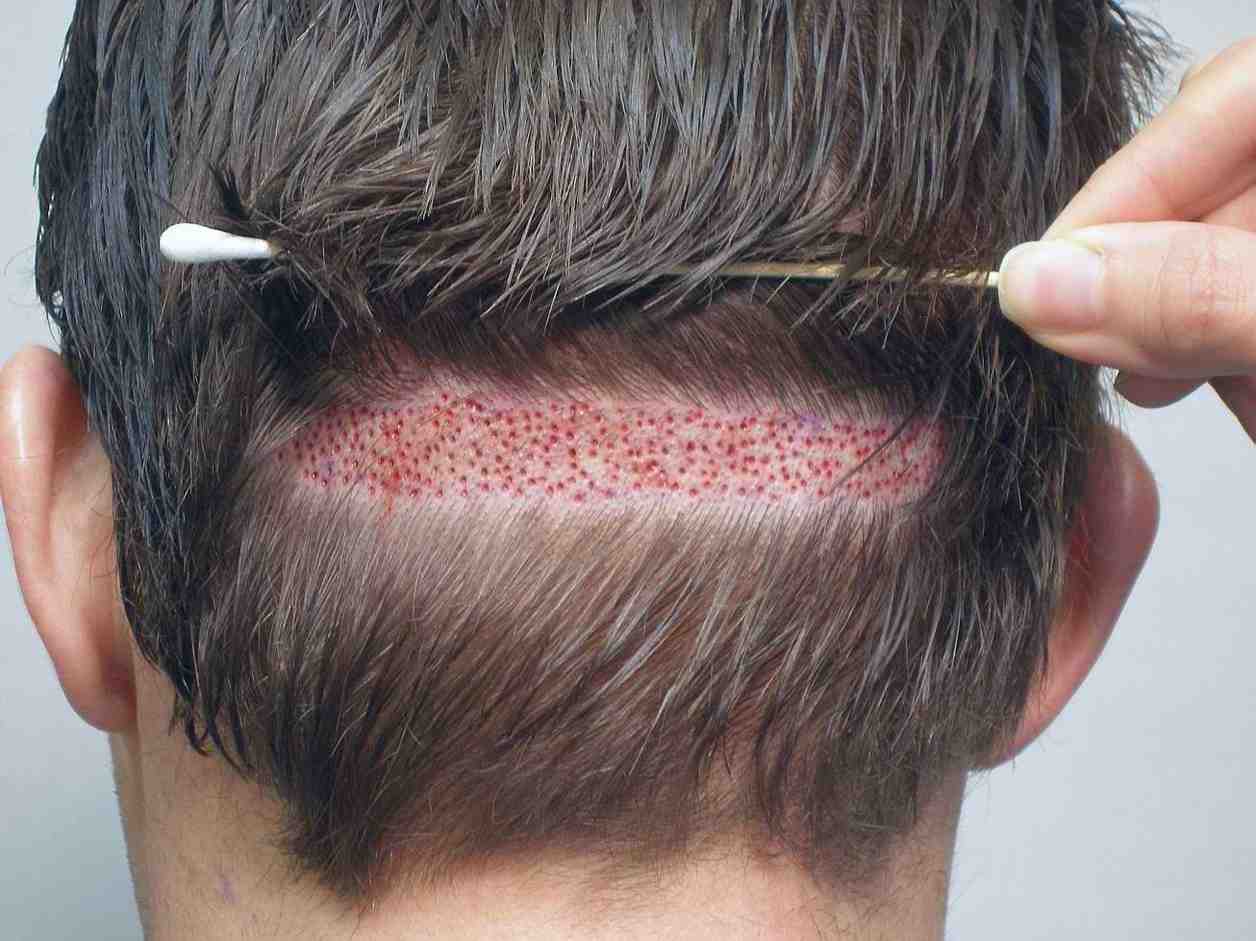 minimally invasive fue procedures for receding hairlines